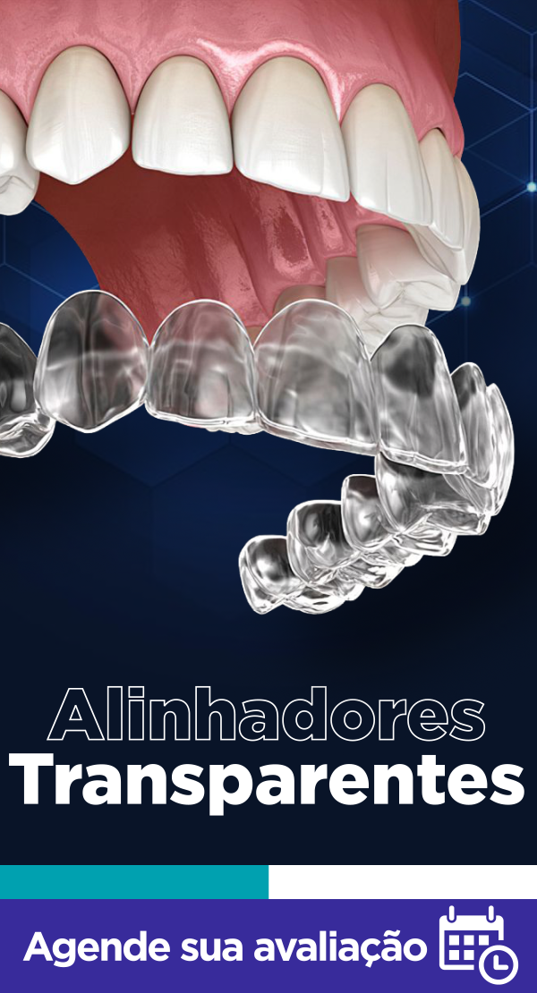Alinhandor sem fios e metais deixando o seu sorriso em evidência!
