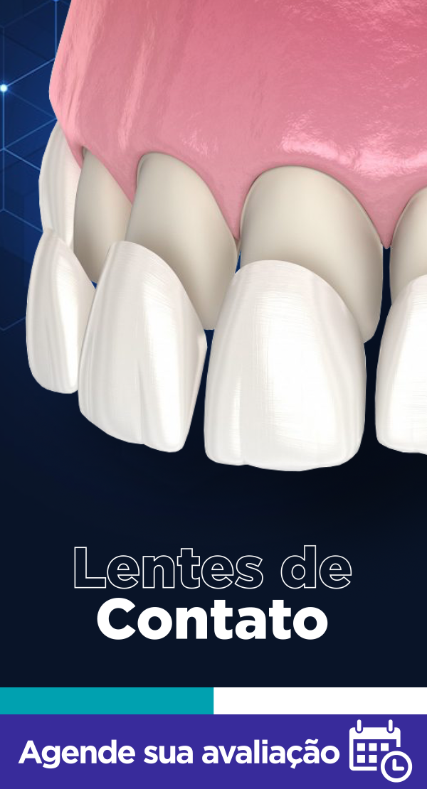Lâminas de Porcelana coladas nos dentes para deixá-los mais brancos, alinhados e sem imperfeições!